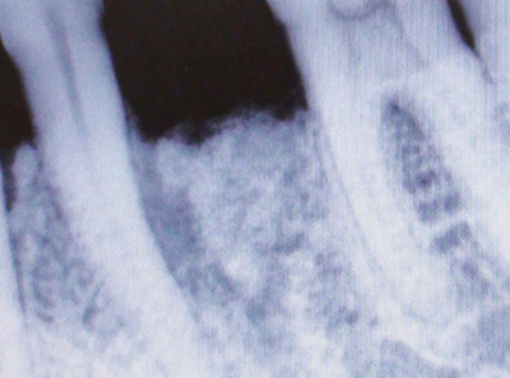 Impianto flapless senza incisione chirurgica