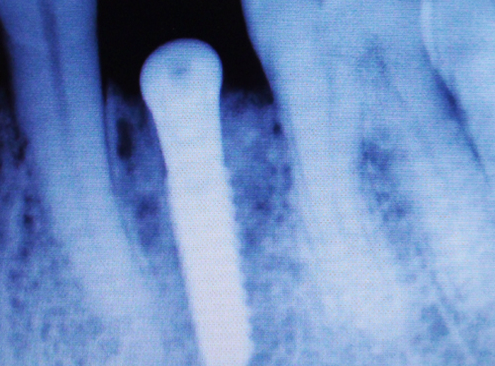 Impianto flapless senza incisione chirurgica