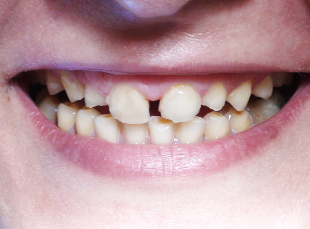 Intervento per eliminare il sorriso molto gengivale