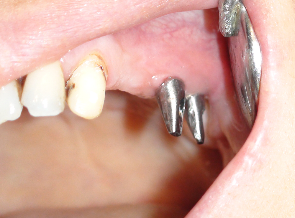 Rigenerazione ossea orizzontale (split crest)